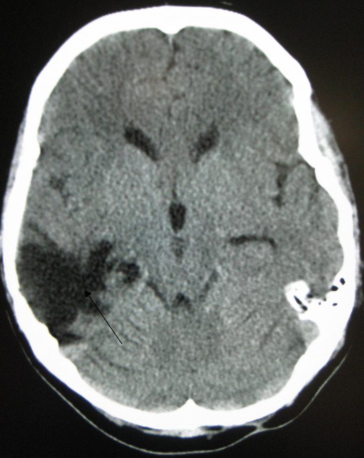 A Ct of the head years after a traumatic brain injury showing an empty space marked by the arrow where the damage occurred. 