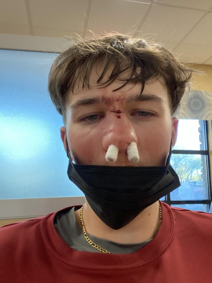 Junior baseball player Zach Agnew was hit in the face in a game against Hamilton. He pitched the ball and it came back and hit him in the face.